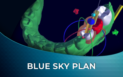 Blue Sky Plan: Implant Treatment Planning and Temporary Restoration Workflow