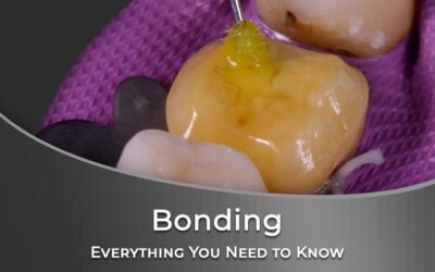 Bonding – Everything You Need to Know