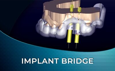 DIW 04 Implant Bridge Digital Workflow
