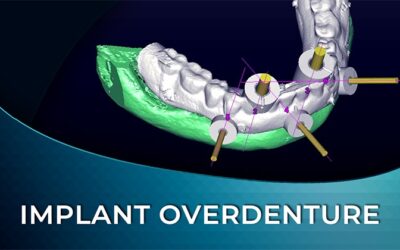 DIW 05 Implant Retained Overdenture Digital Workflow