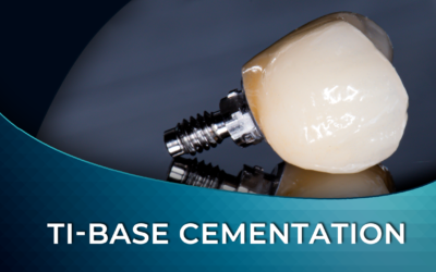 Implant Abutment Cementation Guide