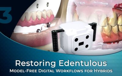 Model-Free Digital Workflows for Edentulous Implant Cases