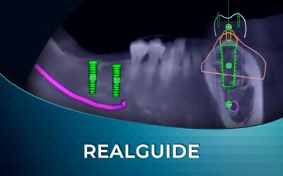 Surgical Guide Design using RealGUIDE Software