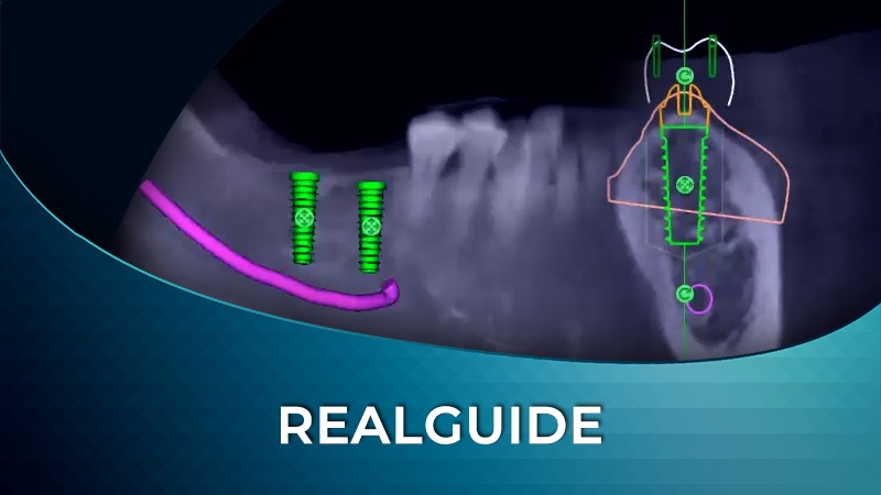 Surgical Guide Design using RealGUIDE Software